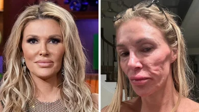 Brandi Glanville Finally Receives Diagnosis For Facial Disfigurement After Blaming A Parasite