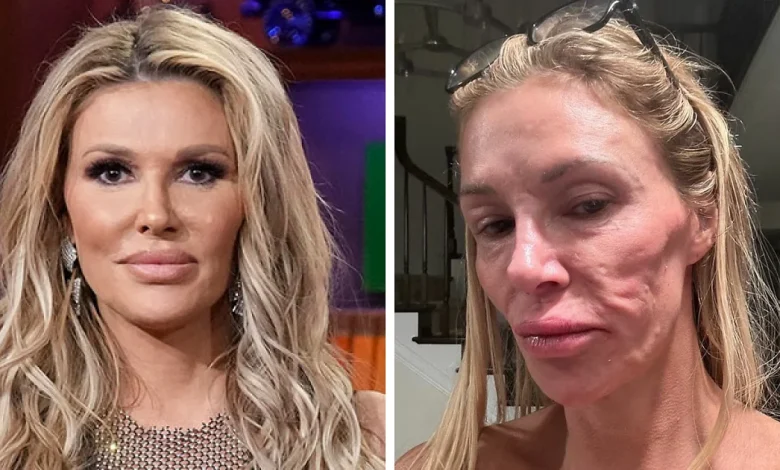 Brandi Glanville Finally Receives Diagnosis For Facial Disfigurement After Blaming A Parasite