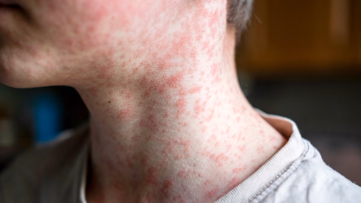 Éclosion de rougeole: 6 cas confirmés au Québec dont au moins un dans le Grand Montréal