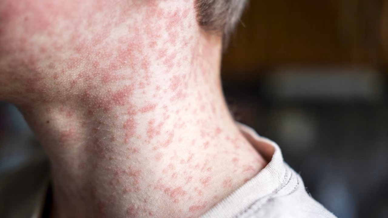 Measles alert for major Australian airport