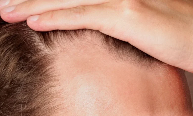 New Baldness Drug Boosted Hair Growth by 539% in Trials