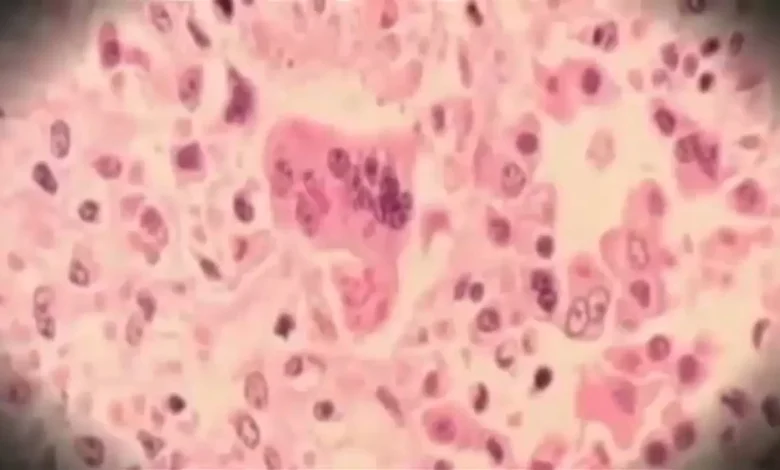 Newark Airport passenger may have exposed others to measles, New Jersey Health Department says