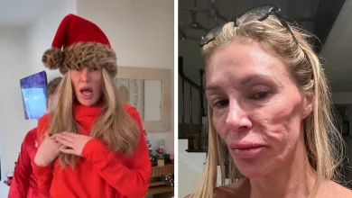 "Psychosis On Display": Brandi Glanville Goes Bold In Red Bikini After Face Disfigurement Diagnosis