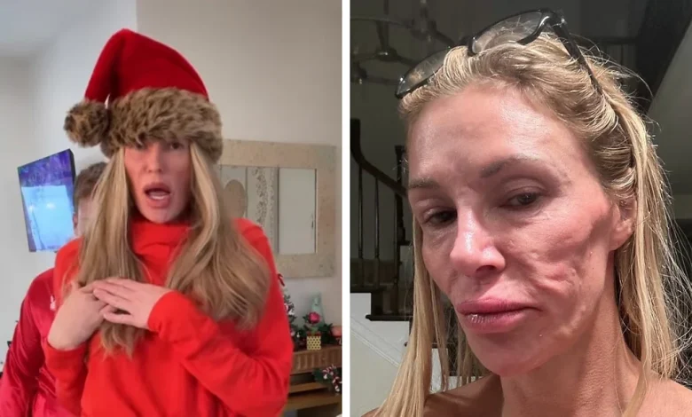 "Psychosis On Display": Brandi Glanville Goes Bold In Red Bikini After Face Disfigurement Diagnosis