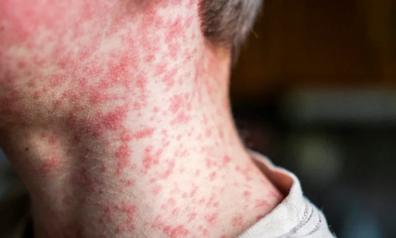South Carolina measles outbreak is 'accelerating,' driving hundreds into quarantine