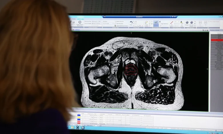 Trial for prostate cancer treatment with fewer side-effects launches in UK