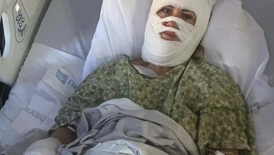 Woman suffers severe burns in a chemical attack at Georgia park