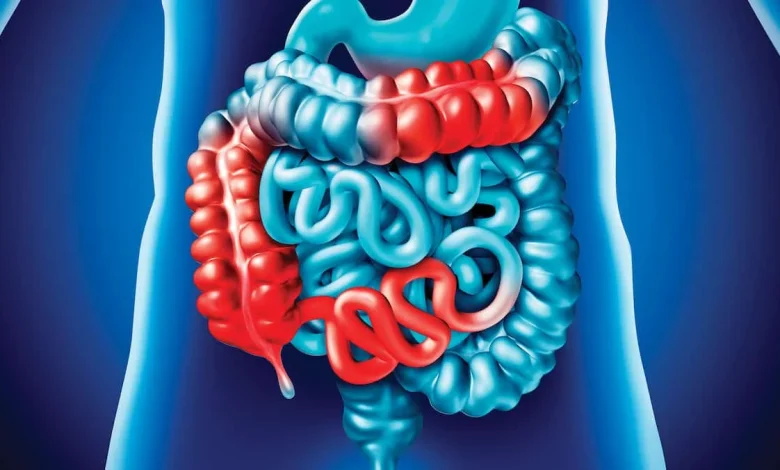 «C’est une épidémie mondiale»: les maladies inflammatoires de l'intestin gagnent du terrain sans que les médecins sachent pourquoi