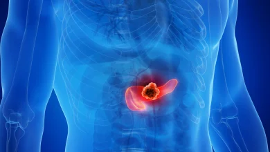 Drug trio found to block tumour resistance in pancreatic cancer
