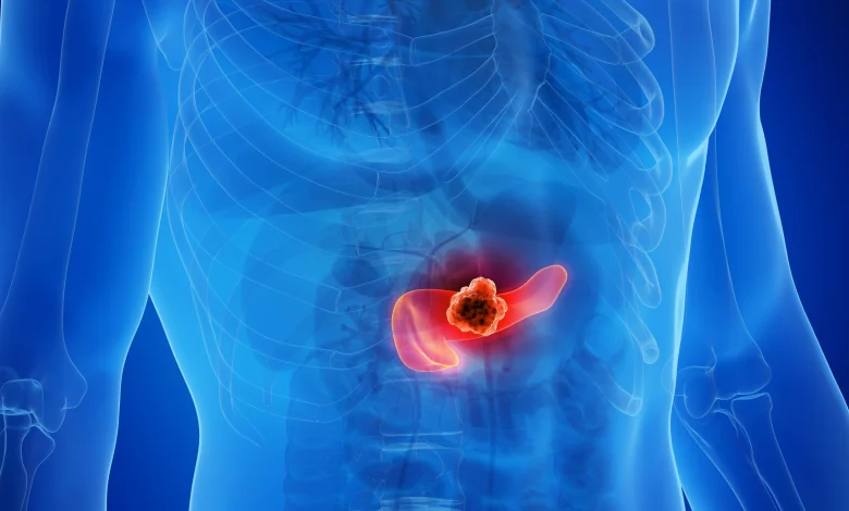 Drug trio found to block tumour resistance in pancreatic cancer