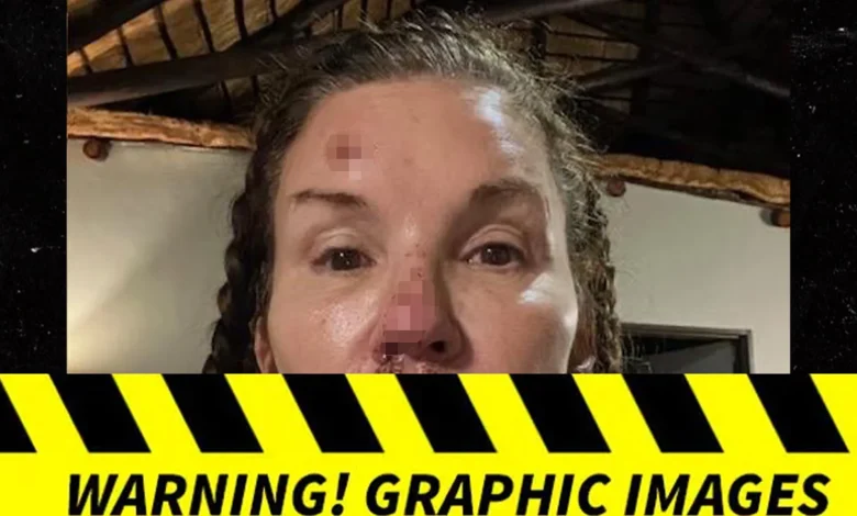 Janice Dickinson's Photos of Alleged Injuries From Nasty Fall on 'I'm A Celebrity'