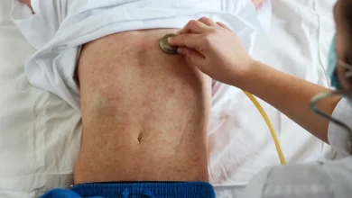 Northern Mindanao sees 11% jump in measles, 74% unvaccinated