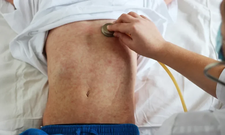 Northern Mindanao sees 11% jump in measles, 74% unvaccinated