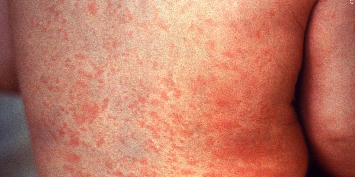 Person in federal custody in Pinal County has the measles, officials say