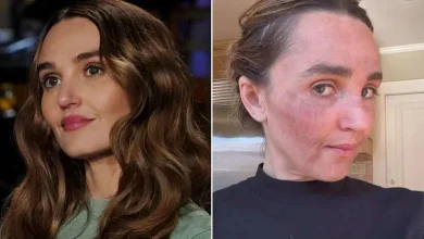 “SNL” star Chloe Fineman posts photo gallery of her 'botched' med spa procedures