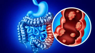 Targeted therapy plus immunotherapy improved outcomes in advanced metastatic colorectal cancer