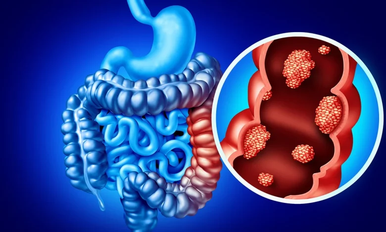 Targeted therapy plus immunotherapy improved outcomes in advanced metastatic colorectal cancer
