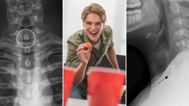 19-year-old’s bizarre beer pong injury required surgery to fix