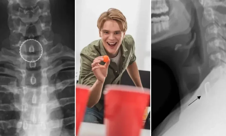 19-year-old’s bizarre beer pong injury required surgery to fix
