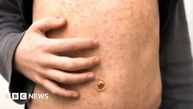 'Fast-spreading' measles outbreak hits several schools in London