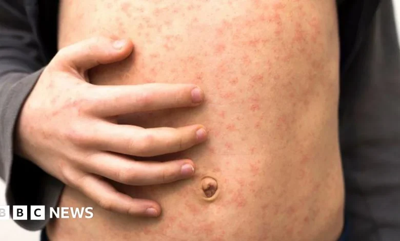 'Fast-spreading' measles outbreak hits several schools in London