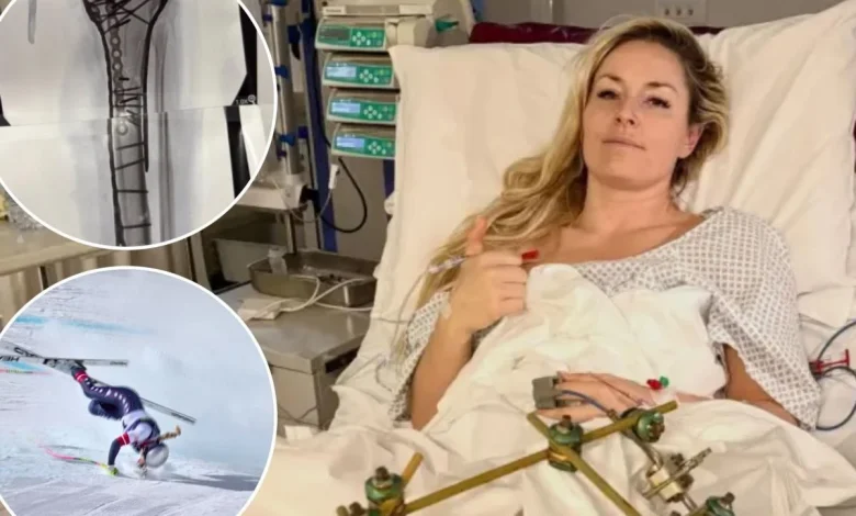 Lindsey Vonn offers gruesome update after Olympic crash: 'Bionic for real now'