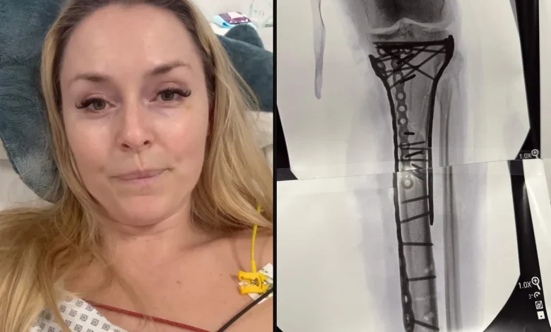 Lindsey Vonn’s ‘car crash’ injury explained: How long could her recovery take and will she ski again?