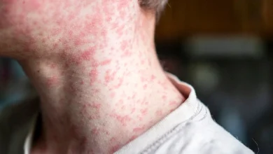New measles exposure location identified in Shasta County