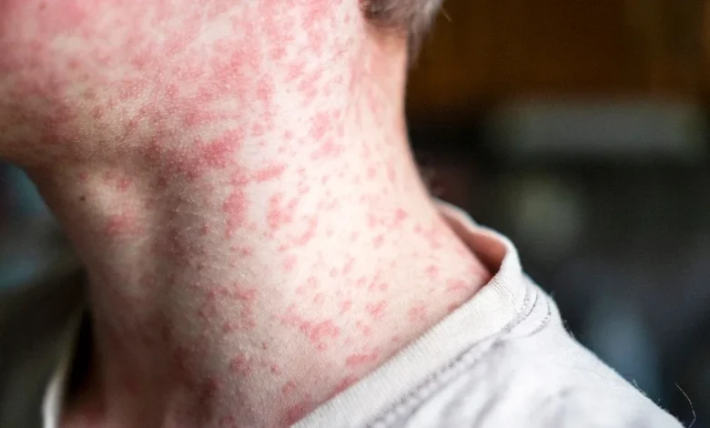 New measles exposure location identified in Shasta County