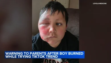 TikTok trend Needoh cube: Boy burned after social media trend; Loyola Medicine shares urgent warning