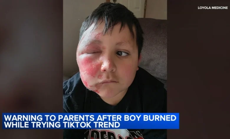 TikTok trend Needoh cube: Boy burned after social media trend; Loyola Medicine shares urgent warning