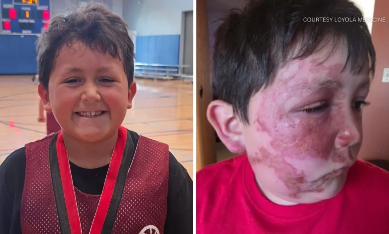 TikTok trend Needoh cube: Plainfield boy, Caleb Grubb, burned after social media trend; Loyola Medicine shares urgent warning