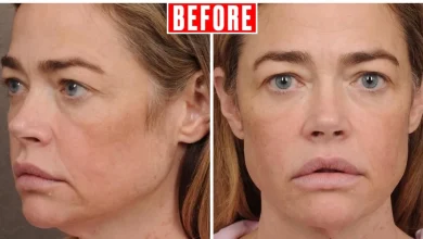 Denise Richards Posts Unreal Before and After Photos of Her Facelift