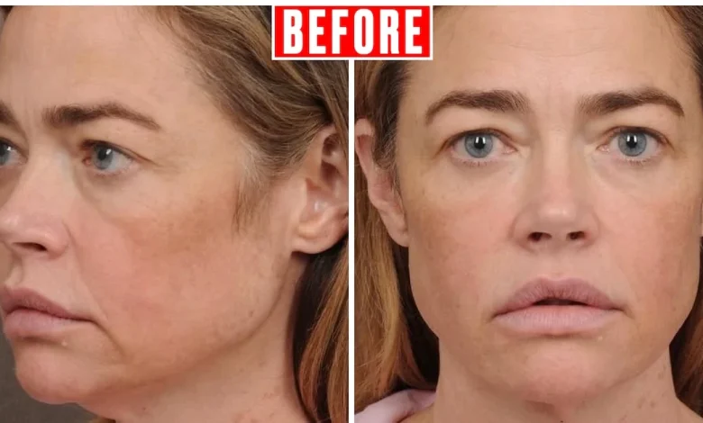 Denise Richards Posts Unreal Before and After Photos of Her Facelift