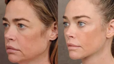 Denise Richards Shares Before-and-After Photos of Shocking Facelift Transformation She Was 'Terrified' to Undergo