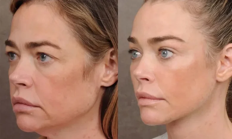 Denise Richards Shares Before-and-After Photos of Shocking Facelift Transformation She Was 'Terrified' to Undergo