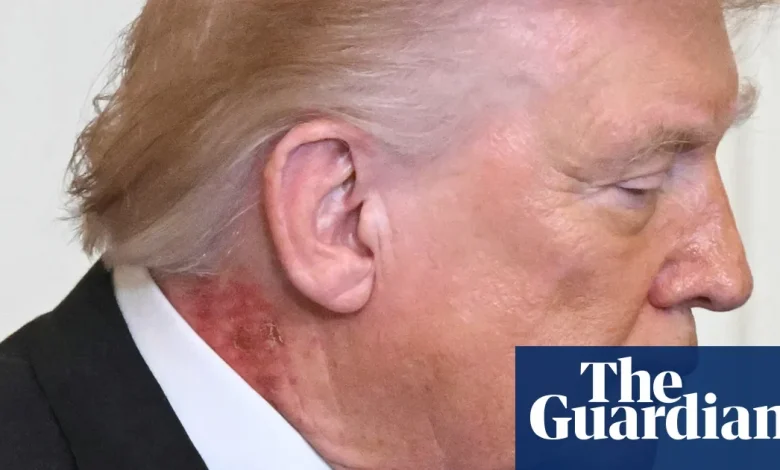 Trump neck rash from ‘preventative’ skin treatment, White House says