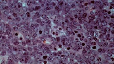 Allogene’s CAR-T could delay or prevent cancer recurrence