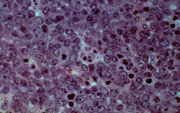 Allogene’s CAR-T could delay or prevent cancer recurrence