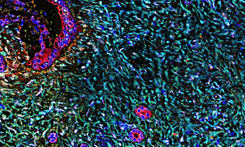 Expert analyzes potential new pancreatic cancer breakthrough