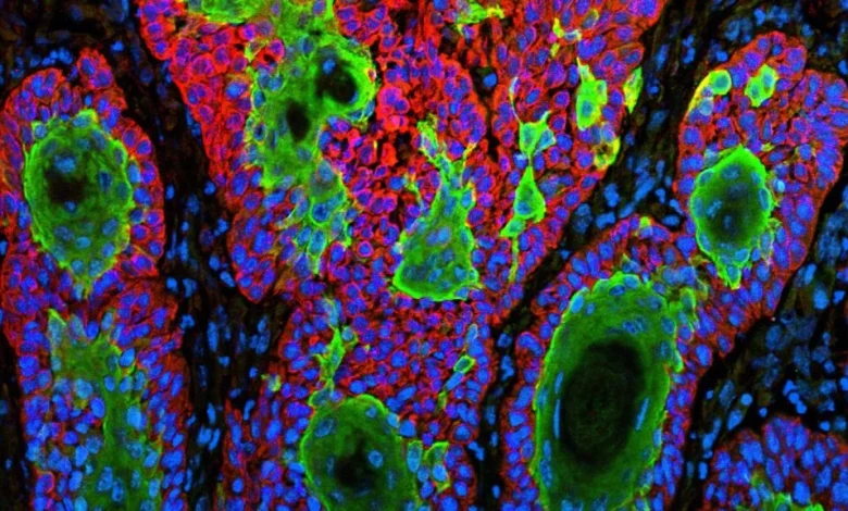 Replimune skin cancer drug that became FDA flashpoint is rejected again