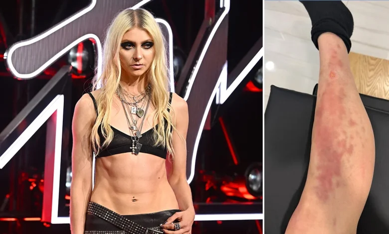 Taylor Momsen rushed to hospital after venomous spider bite during AC/DC tour