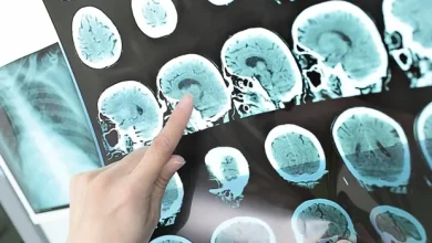 Un faible poids à la naissance augmente le risque d’accident vasculaire cérébral, indépendamment de l’IMC de l’adulte