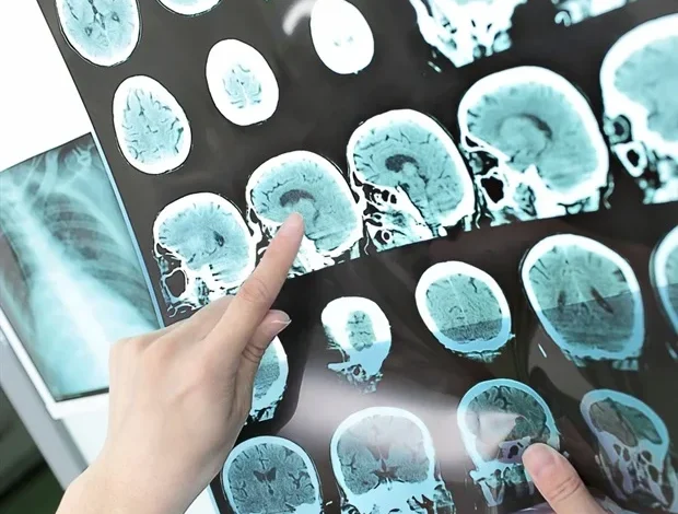 Un faible poids à la naissance augmente le risque d’accident vasculaire cérébral, indépendamment de l’IMC de l’adulte