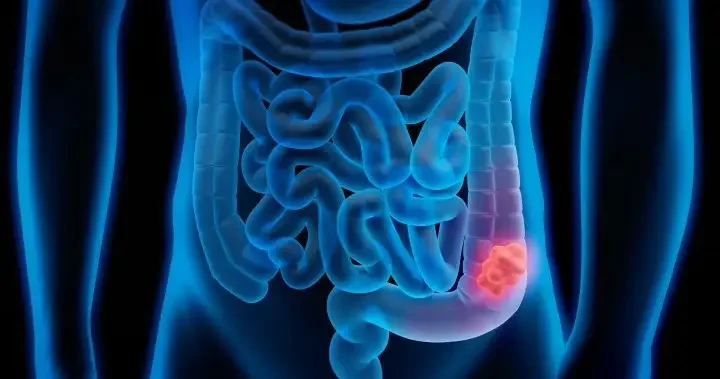 American Cancer Society recommends blood screening for colorectal cancer