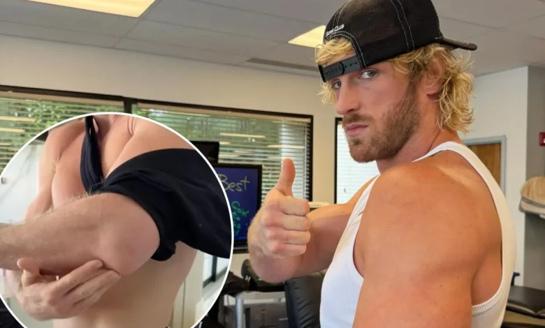 Logan Paul shows off gruesome scar after undergoing arm surgery