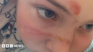 Urgent warning after squishy toy trend caused 'traumatising' burns