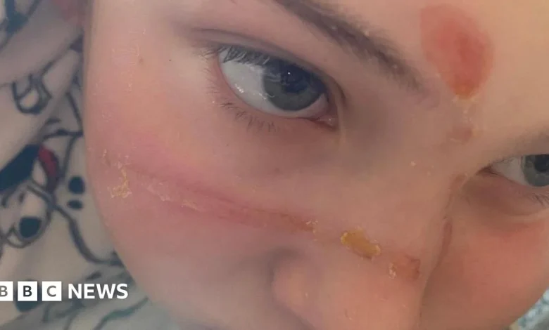 Urgent warning after squishy toy trend caused 'traumatising' burns