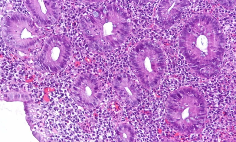 Abivax ulcerative colitis drug shows strong efficacy, but safety concerns arise