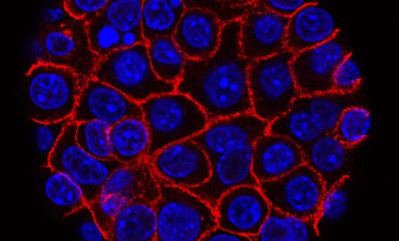 Combo of pancreatic cancer drugs leads to strong response rate